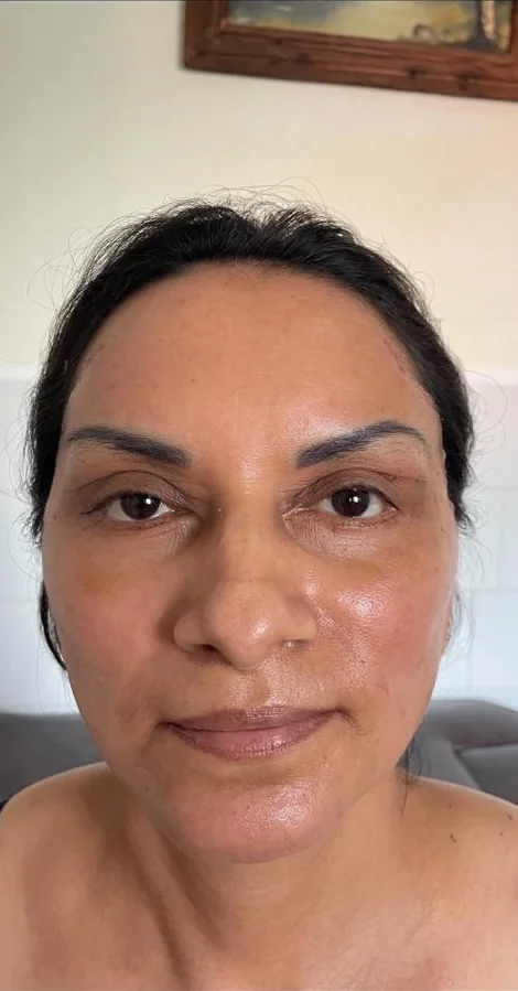 Blefaroplastia