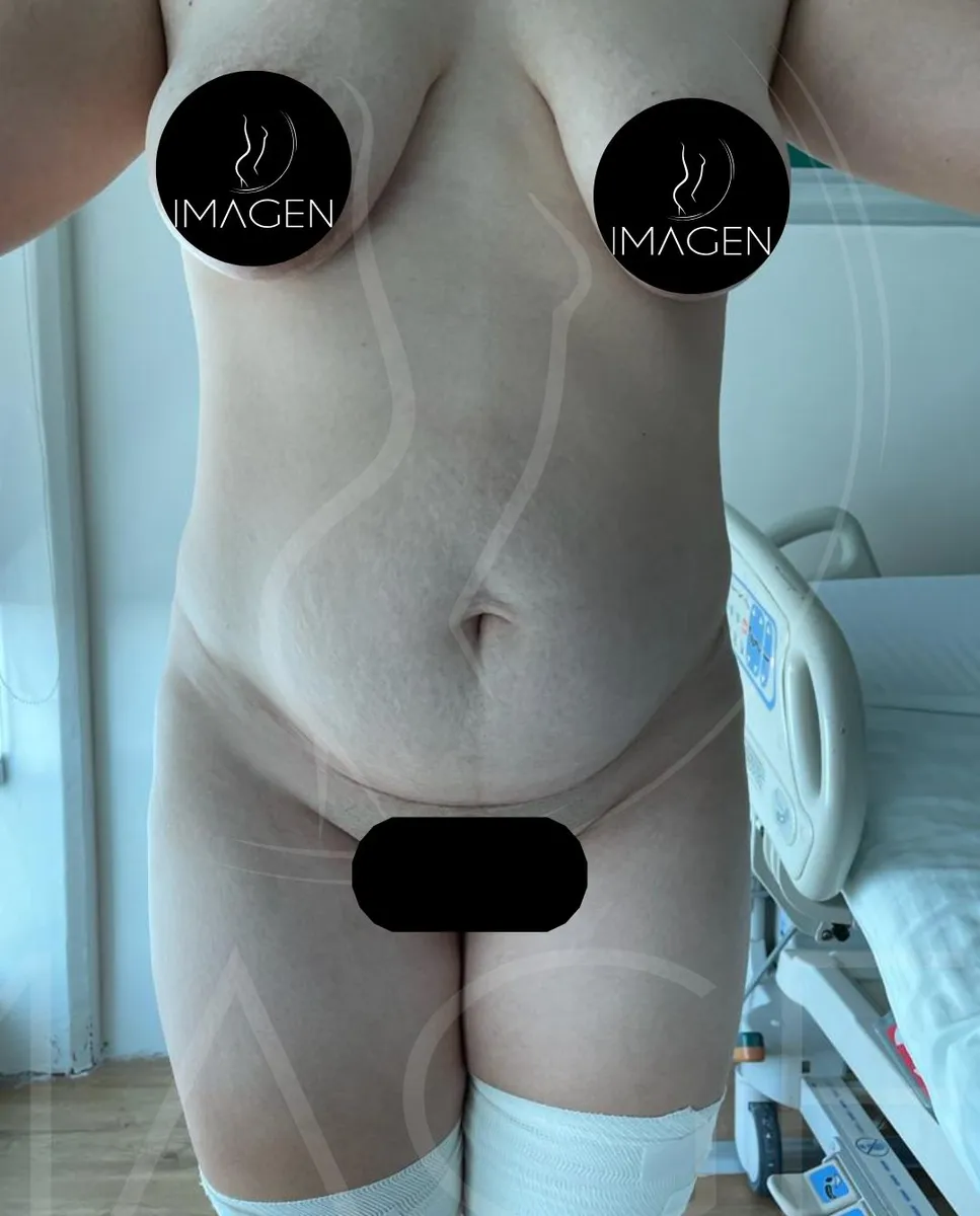 Antes - Abdominoplastía mommy make over