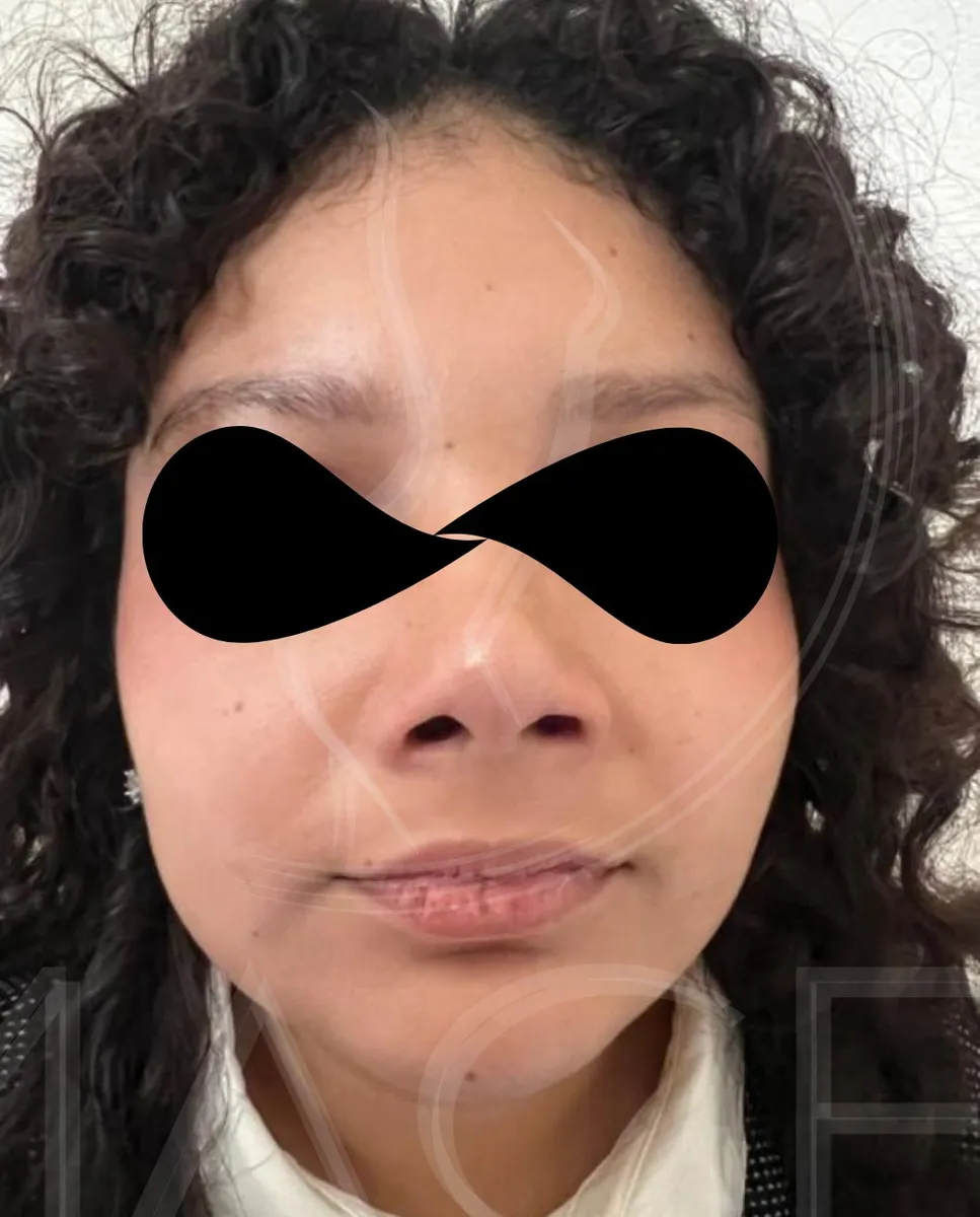Después - Rinoplastía