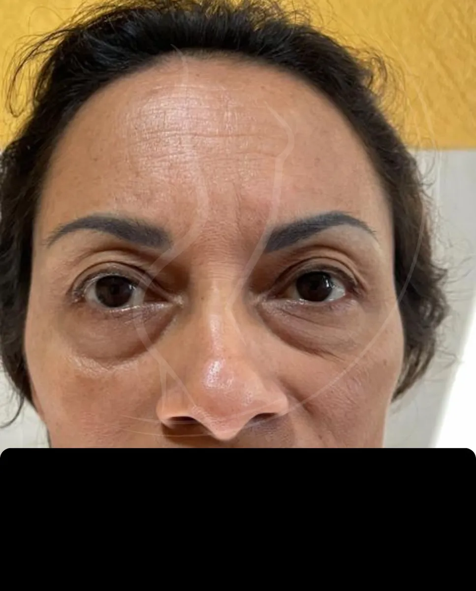 Antes - Blefaroplastia