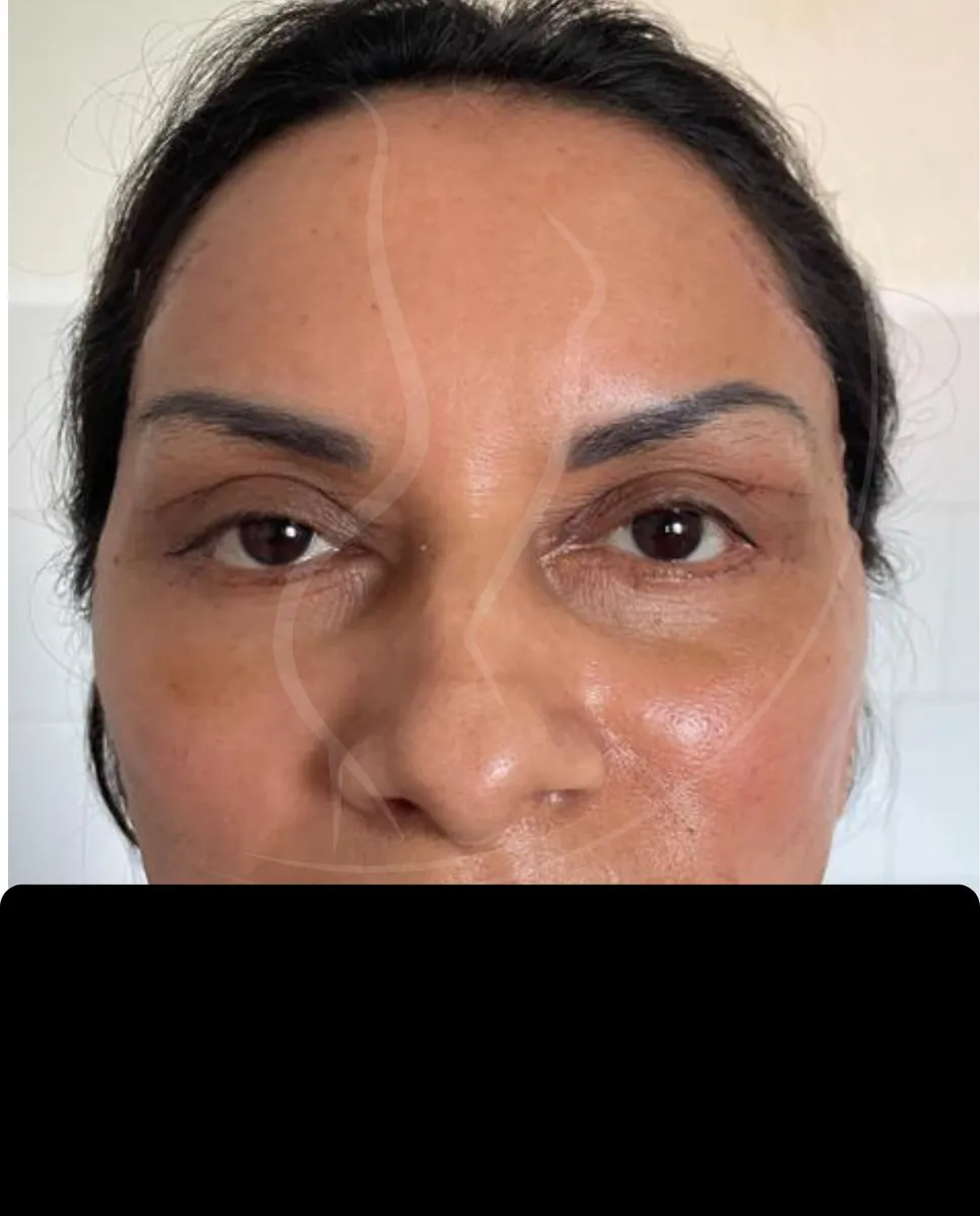 Después - Blefaroplastia