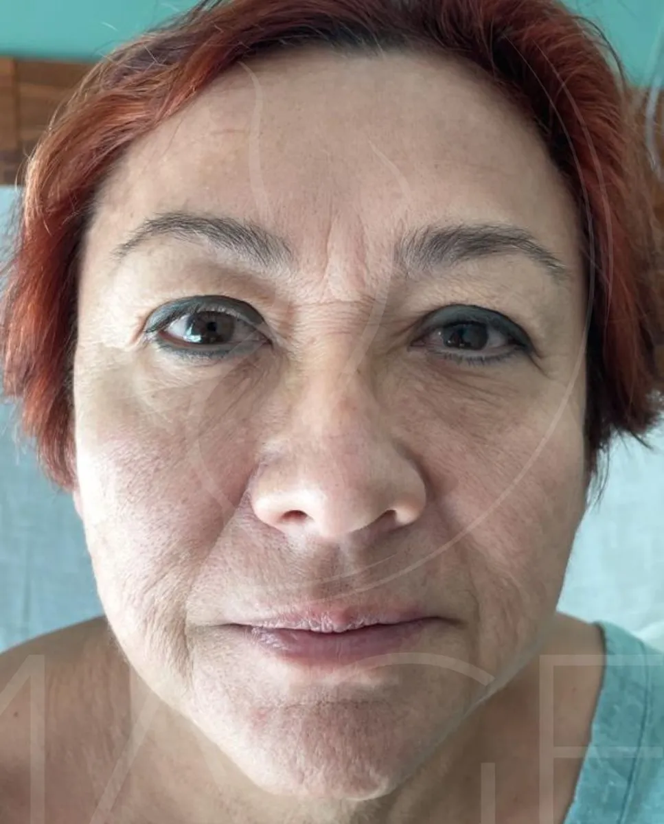 Antes - Lifting facial
