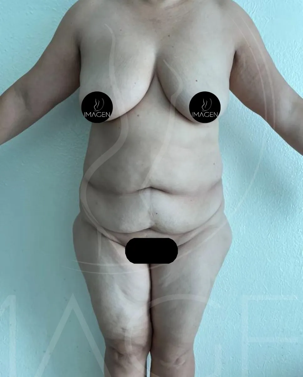 Antes - Abdominoplastía