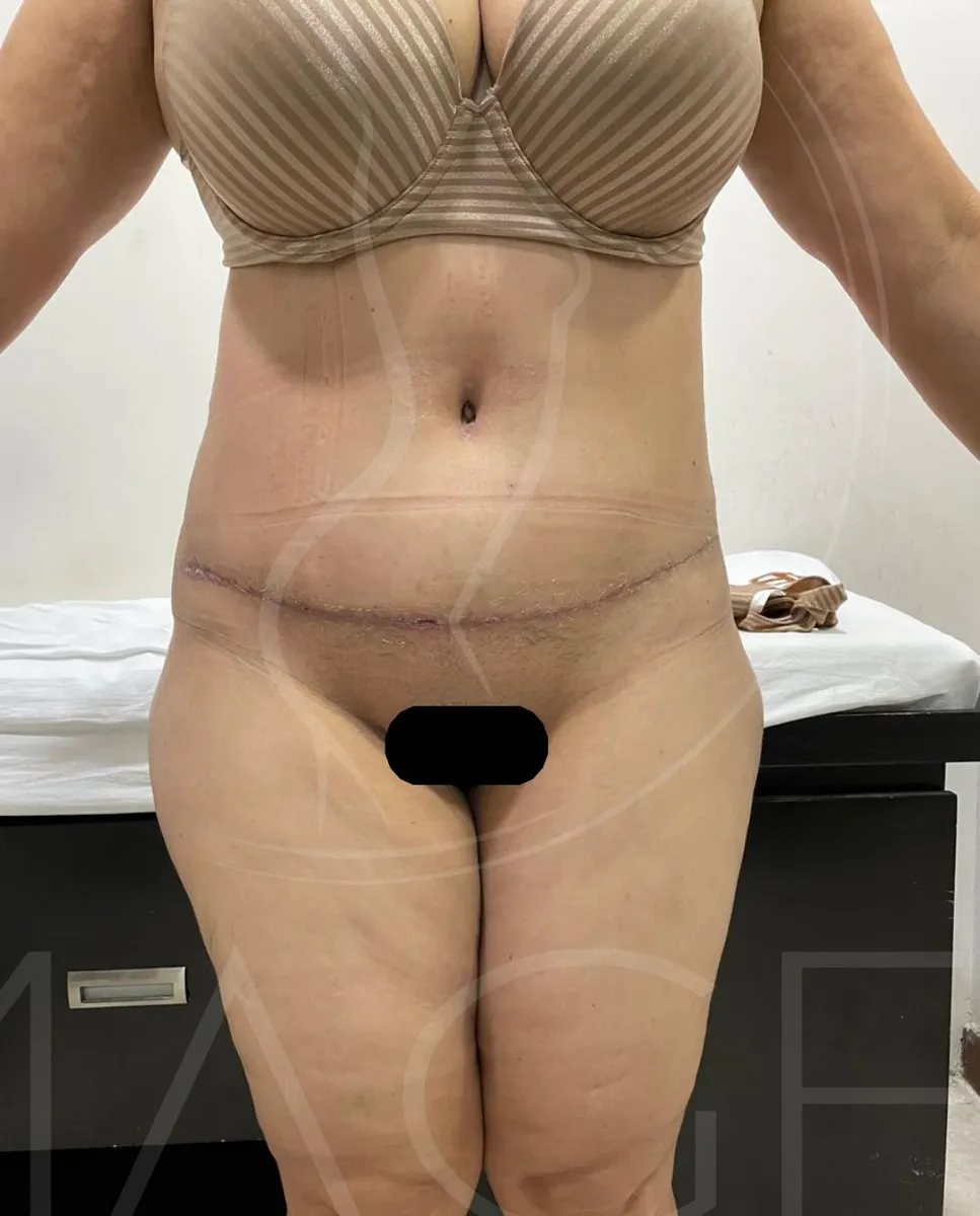 Después - Abdominoplastía