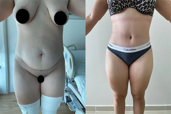 Abdominoplastia y Lipoescultura - Clínica Imagen