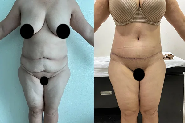 Abdominoplastia y Lipoescultura 360 - Clínica Imagen