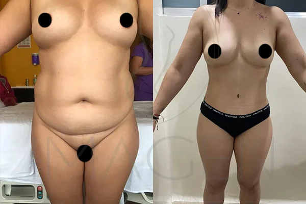 Abdominoplastia y Lipoescultura 360 - Clínica Imagen
