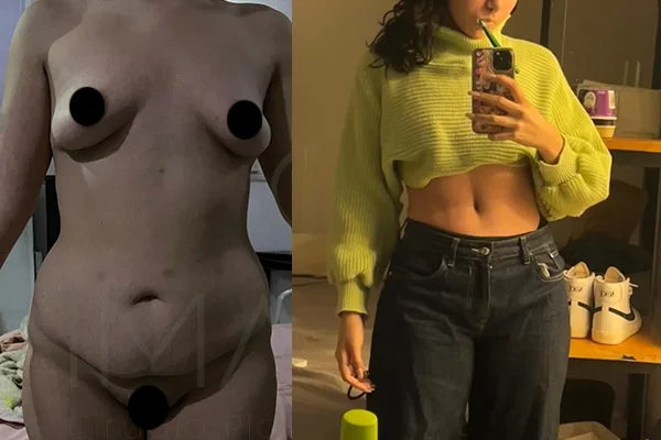 Abdominoplastia y Lipoescultura 360 - Clínica Imagen