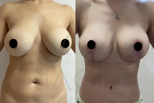 Abdominoplastia, Lipo 360, Cambio de Implantes y Pexia - Clínica Imagen