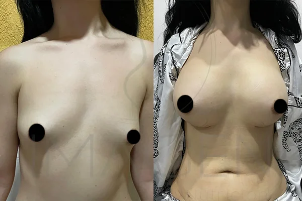 Prótesis Mamarias Anatómicas - Clínica Imagen