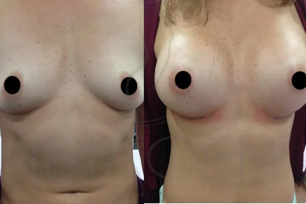 Prótesis Mamarias Redondas - Clínica Imagen