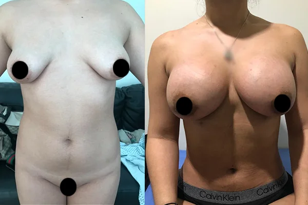 Lipoescultura 360 y Prótesis Mamarias Redondas - Clínica Imagen