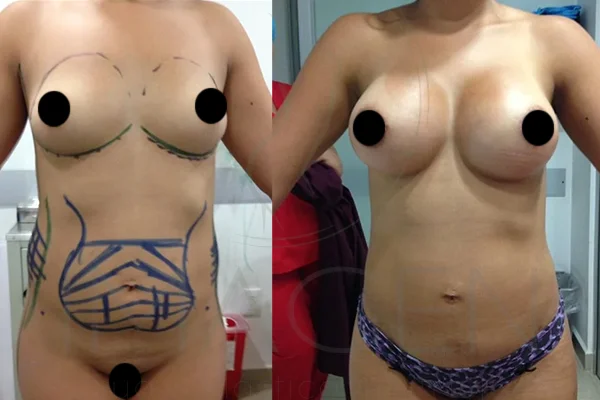 Implantes Mamarios Anatómicos y Lipoescultura - Clínica Imagen