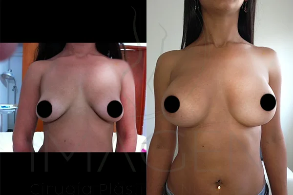 Implantes Mamarios Redondos - Clínica Imagen