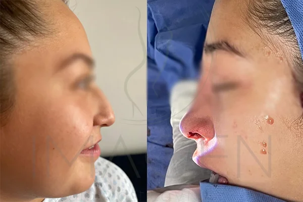 Rinoseptoplastia - Clínica Imagen