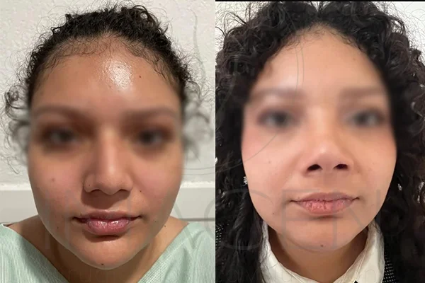 Rinoseptoplastia - Clínica Imagen