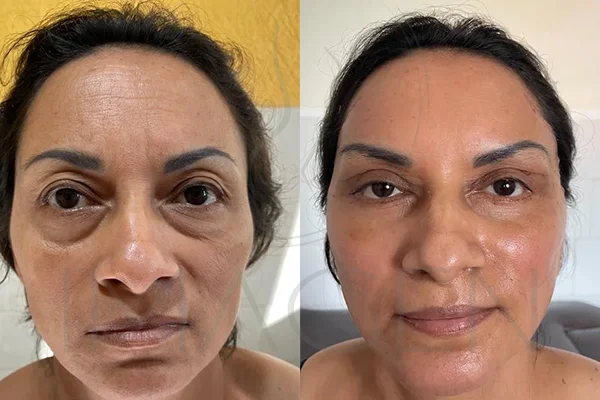 Blefaroplastia - Clínica Imagen