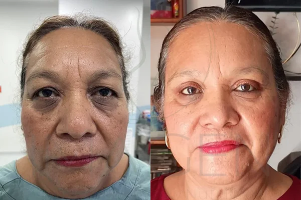 Blefaroplastia - Clínica Imagen