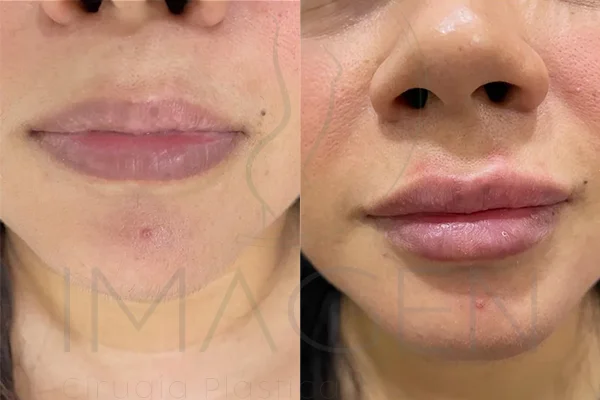 Relleno de Labios con Ácido Hialurónico - Clínica Imagen